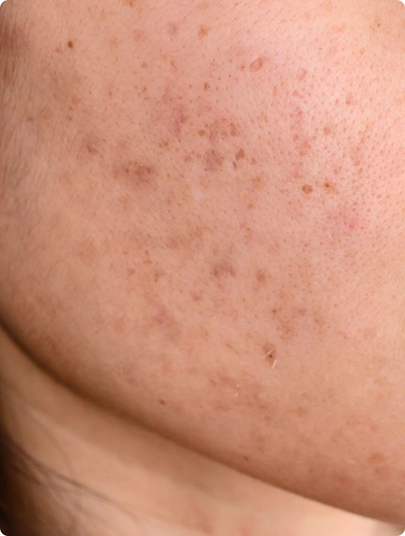 Pigmentation in Bangalore